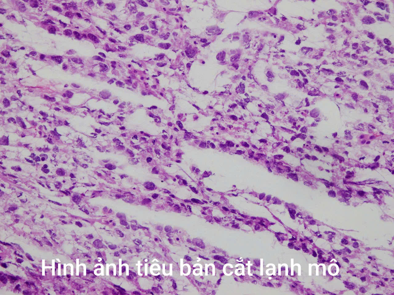Bé trai bất ngờ phát hiện ung thư hiếm gặp: Trẻ có dấu hiệu này, phụ huynh tuyệt đối không chủ quan - Ảnh 2.