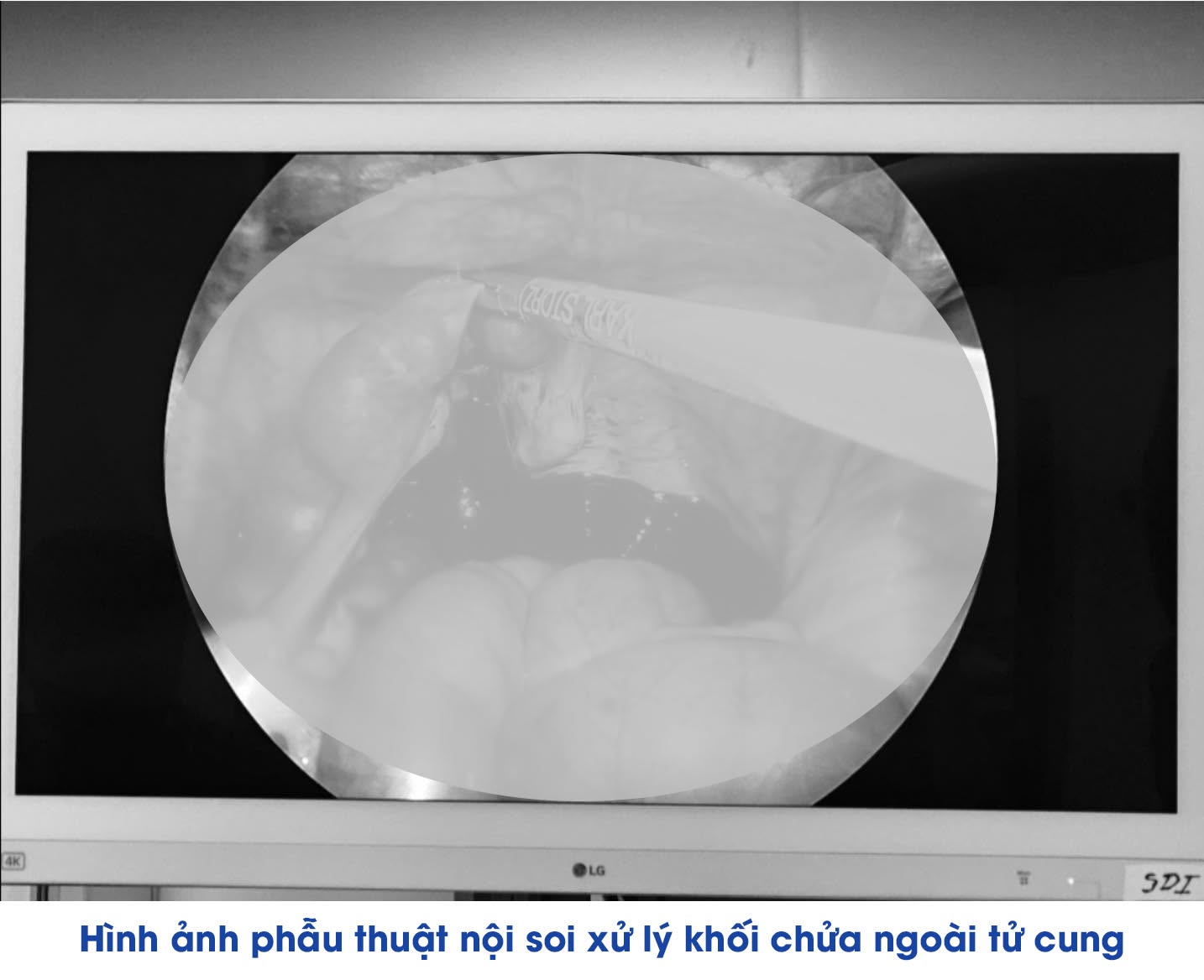 Li&ecirc;n tiếp cứu sống nhiều phụ nữ chửa ngo&agrave;i tử cung vỡ tại Bệnh viện Đa khoa Khu vực V&acirc;n Đồn - Ảnh 2.