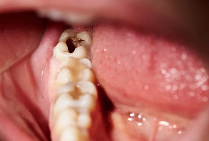Người đàn ông 57 tuổi bị sùi van tim vì chủ quan với sâu răng: Bất ngờ vì những biến chứng! 2 Người đàn ông 57 tuổi bị sùi van tim vì chủ quan với sâu răng: Bất ngờ vì những biến chứng! - Ảnh 2.