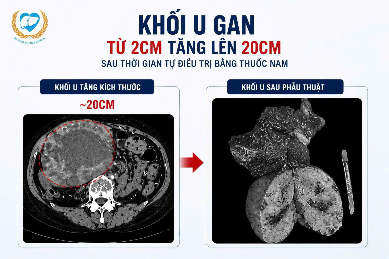 Người phụ nữ 67 tuổi ở Hà Nội mang khối u gan phình gấp 10 lần chỉ sau vài tháng dùng thuốc nam truyền miệng 1 Người phụ nữ 67 tuổi ở Hà Nội mang khối u gan phình gấp 10 lần chỉ sau vài tháng dùng thuốc nam truyền miệng - Ảnh 1.