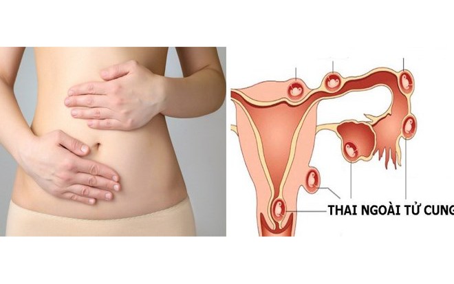 Đau bụng khi đi du lịch, người phụ nữ 28 tuổi sốc mất m&aacute;u v&igrave; thai ngo&agrave;i tử cung vỡ - Ảnh 2.