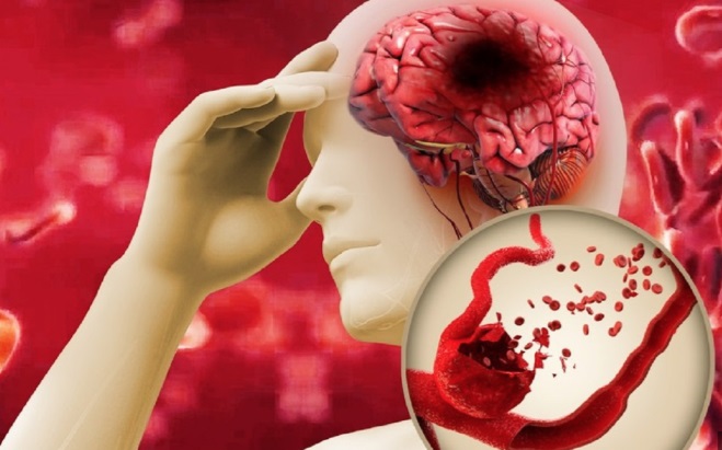 Vì sao đột quỵ tăng cao trong mùa nóng? Nhóm người này cần đặc biệt cảnh giác, đặc biệt sau tuổi 50 - Ảnh 2.