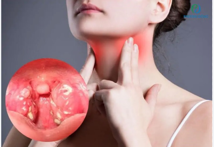 Đau họng kéo dài 3 tuần, người đàn ông 60 tuổi đi khám phát hiện ung thư amidan giai đoạn 4 - Ảnh 3.