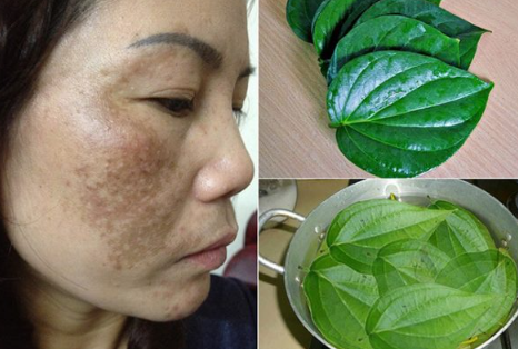 M&aacute;ch bạn 4 c&aacute;ch trị n&aacute;m l&acirc;u năm từ thi&ecirc;n nhi&ecirc;n, rẻ tiền nhưng cực nhạy - Ảnh 4.
