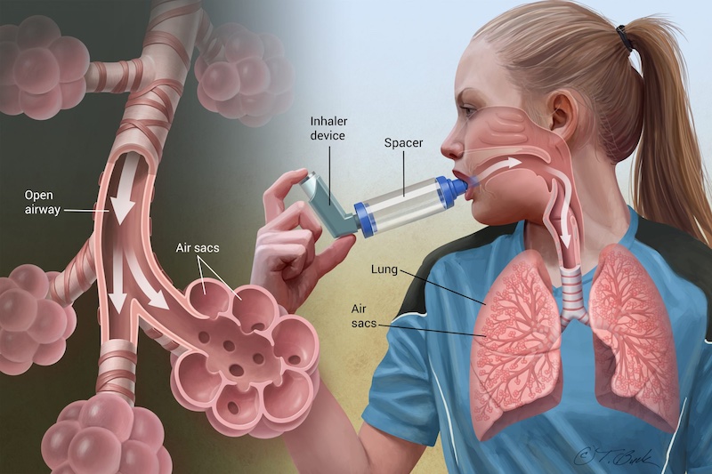 Liệu ph&aacute;p sinh học - giải ph&aacute;p điều trị hen suyễn mới - Ảnh 1.