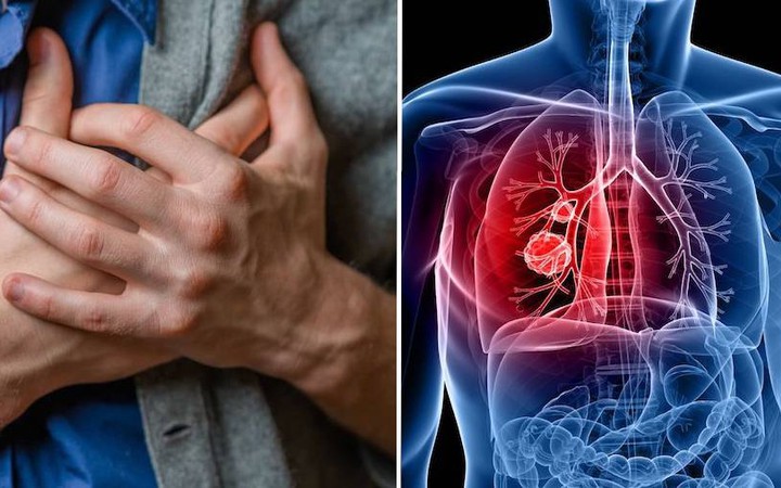 Người đ&agrave;n &ocirc;ng mắc ung thư phổi thừa nhận sai lầm nhiều người Việt mắc phải - Ảnh 2.