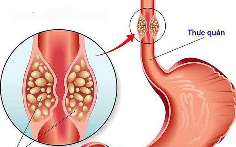 Nam sinh 16 tuổi vi&ecirc;m lo&eacute;t thực quản v&igrave; thường xuy&ecirc;n uống loại nước vạn người m&ecirc; - Ảnh 3.