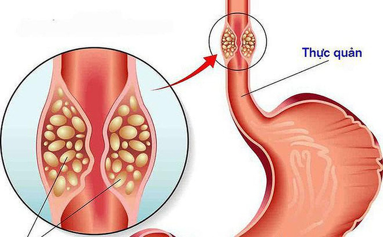 Cô gái 26 tuổi bị loét thực quản vì thói quen nhiều người Việt mắc phải khi uống thuốc 1 Cô gái 26 tuổi bị loét thực quản vì thói quen nhiều người Việt mắc phải khi uống thuốc - Ảnh 1.