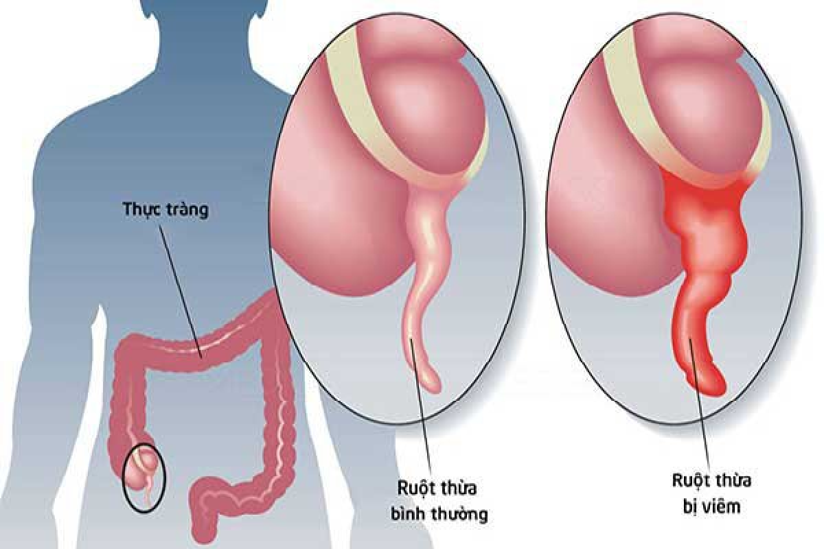 Chủ quan với đau bụng âm ỉ, người đàn ông suýt vỡ ruột thừa vì nghĩ chỉ rối loạn tiêu hóa - Ảnh 1.