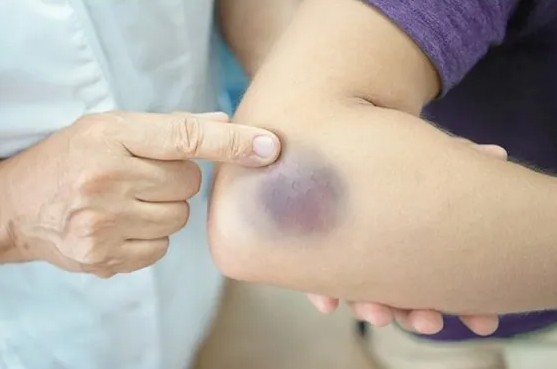 Bác sĩ cảnh báo 2 thực phẩm làm tăng nguy cơ ung thư, nhiều người Việt vẫn dùng mỗi ngày - Ảnh 4.