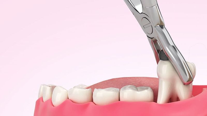 Nhổ răng khôn giá bao nhiêu? Cập nhật bảng giá và quy trình nhổ răng khôn không đau tại Nha khoa Nhân Tâm 1 Nhổ răng khôn giá bao nhiêu? Cập nhật bảng giá và quy trình nhổ răng khôn không đau tại Nha khoa Nhân Tâm - Ảnh 1.