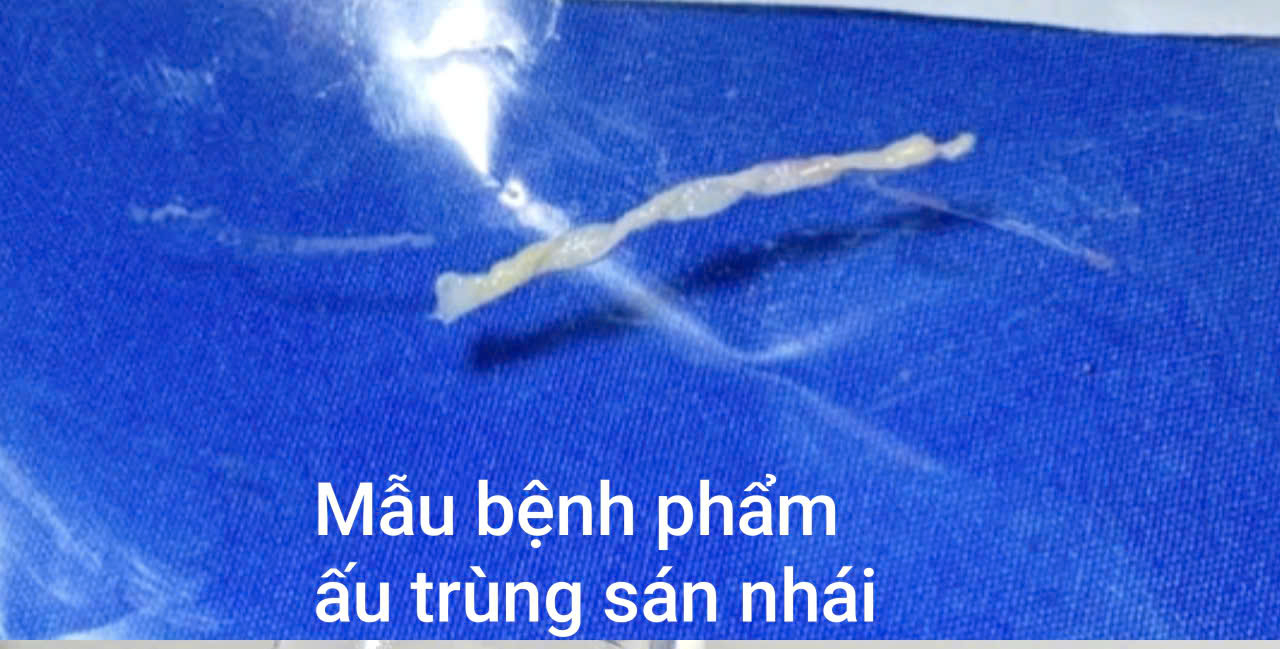 Người đàn ông Hà Nội phát hiện ấu trùng sán nhái dài 7cm ở đùi từ nguyên nhân không ngờ - Ảnh 2.