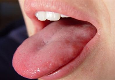 Người phụ nữ 59 tuổi ph&aacute;t hiện tiền ung thư ở lưỡi từ dấu hiệu nhiều người Việt bỏ qua - Ảnh 1.