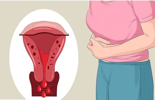 Người phụ nữ 53 tuổi thiếu m&aacute;u nặng v&igrave; chủ quan với u xơ tử cung - Ảnh 1.