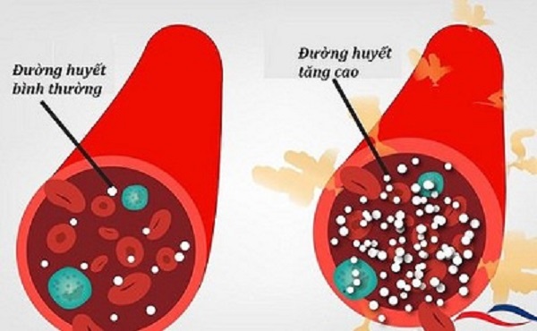 Người đàn ông 30 tuổi tử vong tại bàn làm việc, đường huyết tăng vọt vì bệnh tiểu đường: Bất ngờ từ chế độ ăn - Ảnh 1.