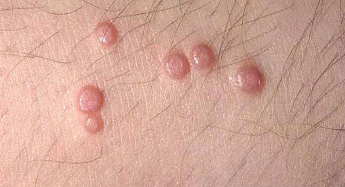 Con đường l&acirc;y truyền mụn c&oacute;c sinh dục - Ảnh 1.