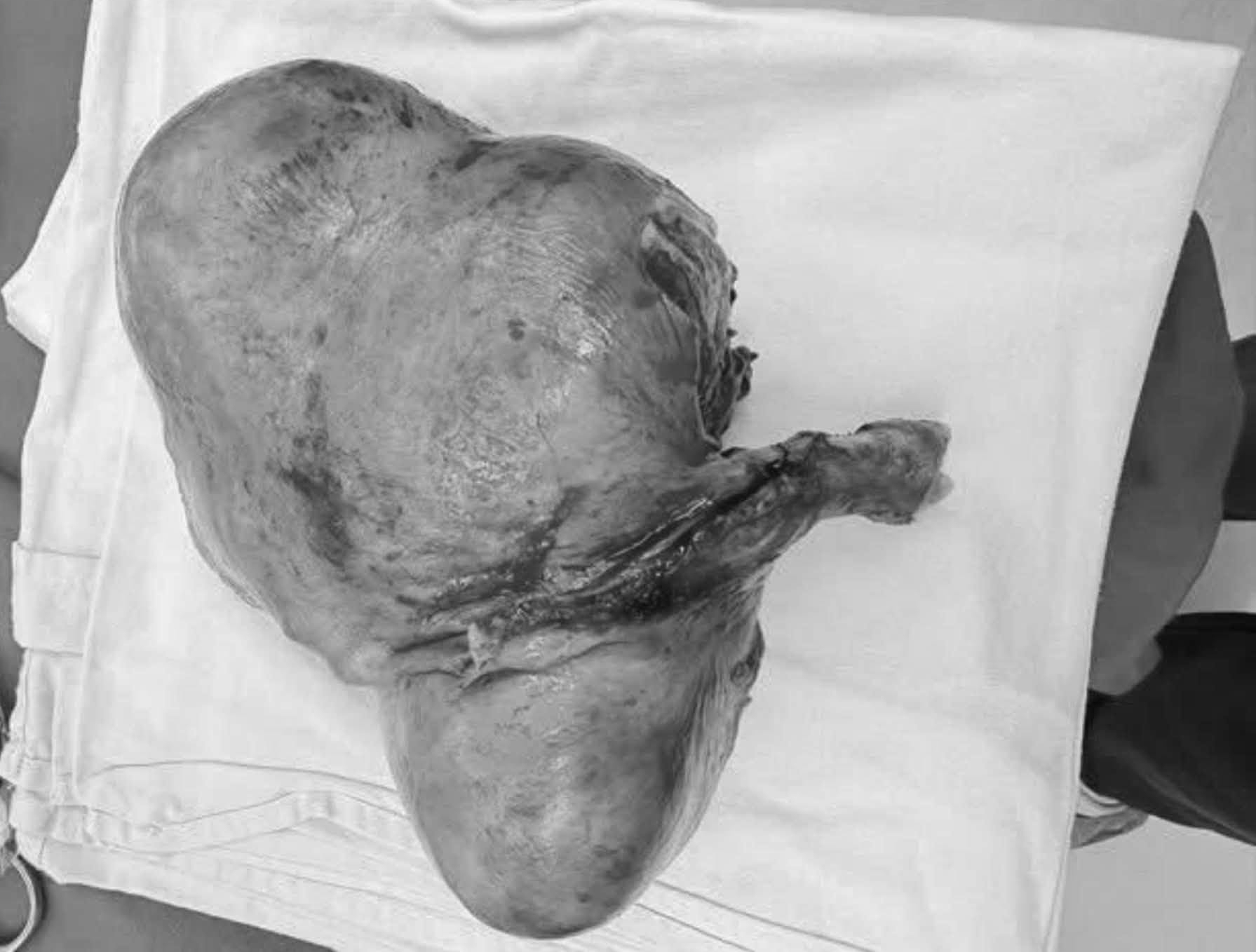 Lấy thành công khối u khủng vùng bụng nặng 1,5kg cho người phụ nữ bị động kinh, chậm phát triển trí tuệ - Ảnh 2.
