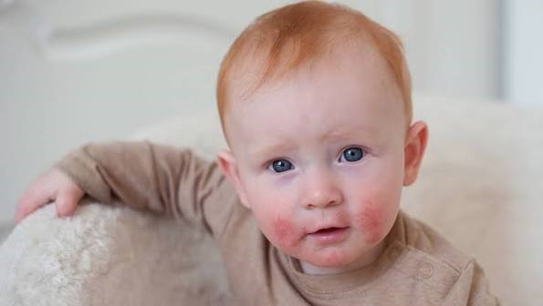 Vi&ecirc;m da ở trẻ nhỏ ảnh hưởng đến b&eacute; nhiều hơn bạn nghĩ - Ảnh 3.