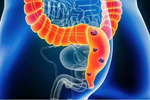 Đau mông kéo dài 4 tháng, người đàn ông 54 tuổi phát hiện ung thư trực tràng giai đoạn 3 - Ảnh 1.