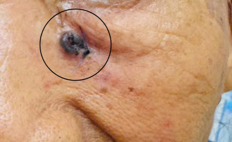 Người phụ nữ 69 tuổi tưởng vết trầy xước trên mặt, đi khám bất ngờ phát hiện ung thư da - Ảnh 1.