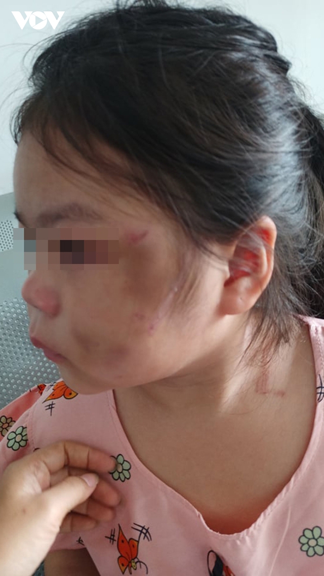 Bé gái 6 tuổi ở Bình Dương bầm tím mặt vì cha “lỡ tay khi dạy học&quot;: Cần mạnh tay xử lý tình trạng bạo hành gia đình - Ảnh 1.