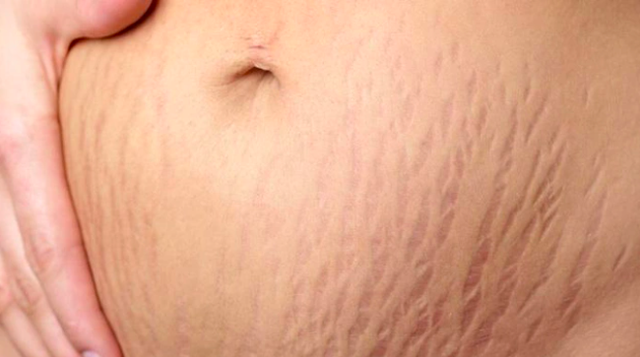 Sai lầm thường gặp khi điều trị rạn da trong và sau sinh - Ảnh 3.