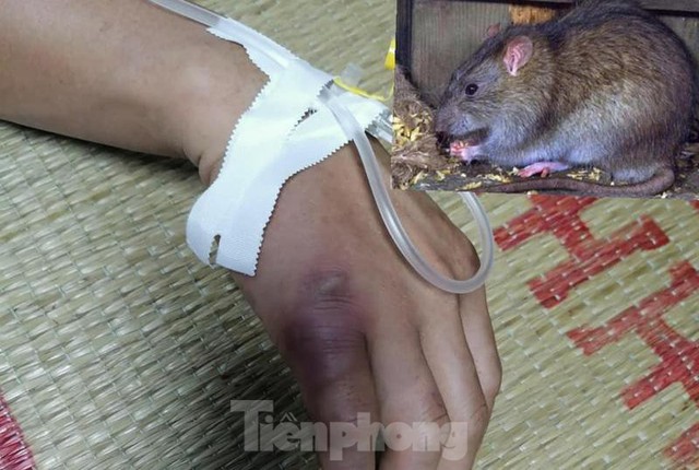  Suýt mất mạng vì sốt hạch nghi chuột rừng cắn  - Ảnh 1.