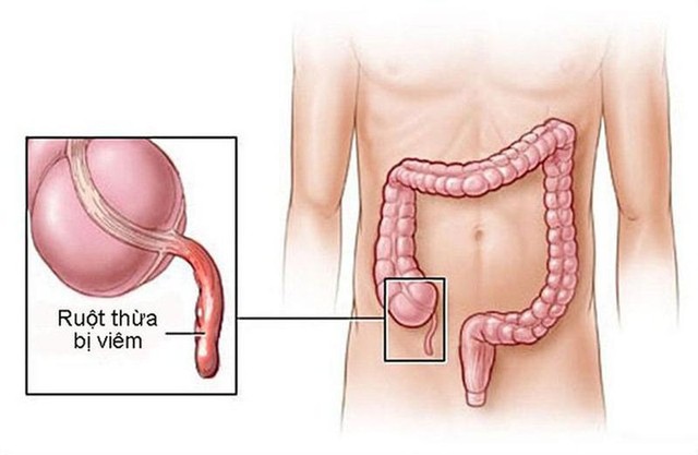 BVĐK MEDLATEC cấp cứu thành công bé gái 10 tuổi bị viêm ruột thừa cấp - Ảnh 2.