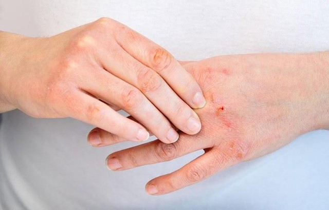 Cải thiện viêm da cơ địa (chàm, eczema) tại nhà bằng bộ đôi từ thiên nhiên - Ảnh 1.