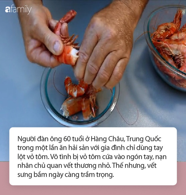 Chỉ làm duy nhất việc này trước khi ăn tôm và người đàn ông tử vong: Chuyên gia cảnh báo nguy cơ khi ăn hải sản có vỏ! - Ảnh 2.