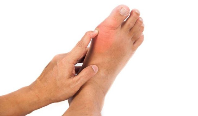Giảm đau gút ở khớp ngón chân cái an toàn nhờ sản phẩm thảo dược - Ảnh 1.