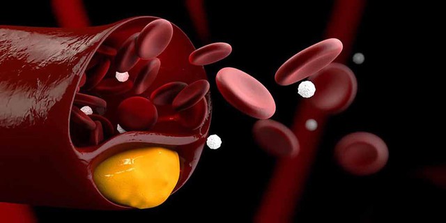 Sản phẩm thảo dược hạ mỡ máu: Xu hướng mới giúp giảm cholesterol, hỗ trợ điều trị mỡ máu cao an toàn, hiệu quả - Ảnh 1.
