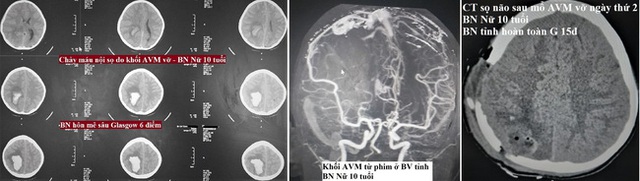 Bé gái 10 tuổi đã bị dị dạng động tĩnh mạch, phải chuyển tới Trung tâm Đột quỵ cấp cứu: Cảnh báo căn bệnh nguy hiểm - Ảnh 1.