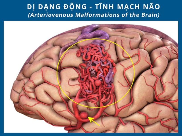 Bé gái 10 tuổi đã bị dị dạng động tĩnh mạch, phải chuyển tới Trung tâm Đột quỵ cấp cứu: Cảnh báo căn bệnh nguy hiểm - Ảnh 4.