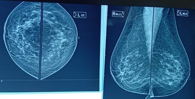 Phụ nữ có bộ ngực lớn, mô vú dày có thể đối mặt với nguy cơ ung thư vú - Ảnh 2.
