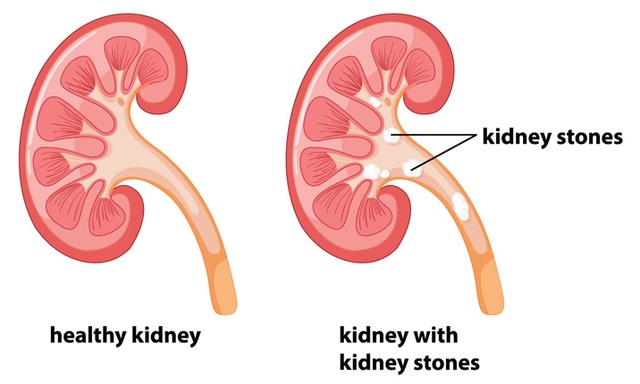 Sỏi thận – liệu có cần phải phẫu thuật hay không? - Ảnh 1.