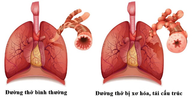 Bí quyết hỗ trợ long đờm, giảm ho, cải thiện khó thở do viêm phổi mạn tính từ thiên nhiên - Ảnh 1.