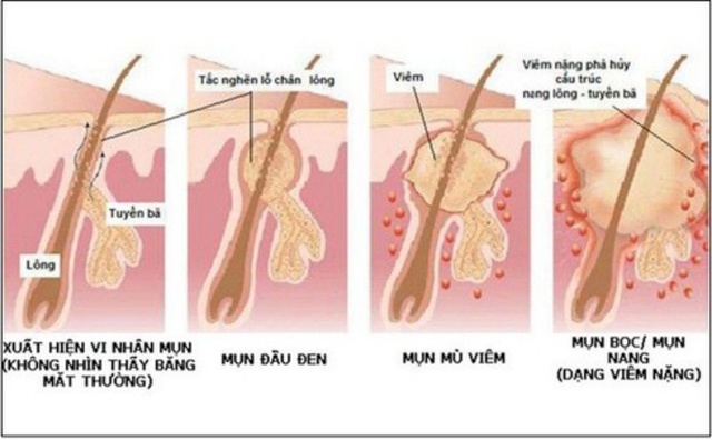 Giãn cách, chị em tự tin đánh bay mụn bọc với 3 món này - Ảnh 2.