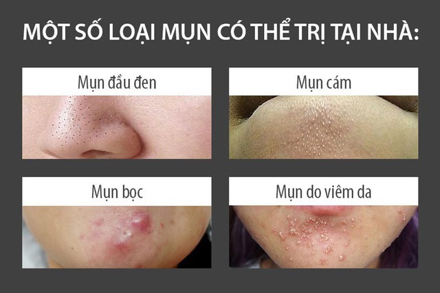 Giãn cách, chị em tự tin đánh bay mụn bọc với 3 món này - Ảnh 3.