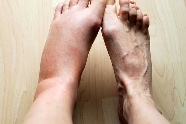Nhìn bàn chân đoán bệnh: Có 4 điểm bất thường trên bàn chân, cần đi khám thận khẩn cấp - Ảnh 4.