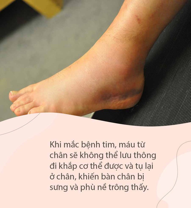 Người có nguy cơ cao mắc bệnh tim thường xuất hiện 3 dấu hiệu cực rõ ở chân, kiểm tra ngay xem bạn có không - Ảnh 4.