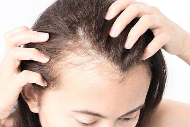 Chuyên gia chỉ rõ 5 nguyên nhân chính gây rụng tóc và đây là 6 nhóm thực phẩm cần nhất cho mái tóc đẹp - Ảnh 3.