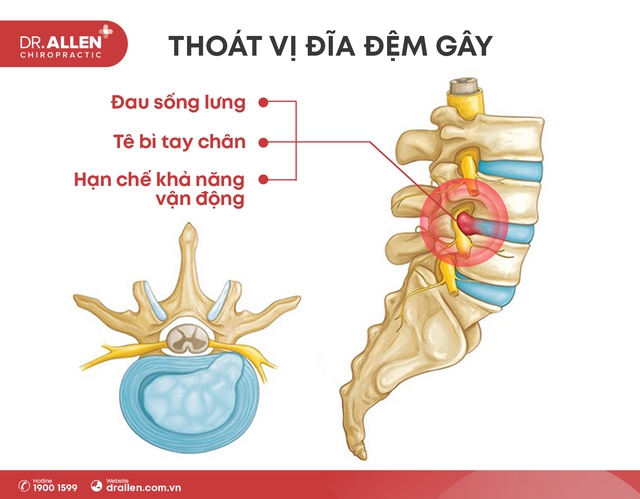 DR.ALLEN CHIROPRACTIC - CHỮA THOÁT VỊ ĐĨA ĐỆM BẰNG PHƯƠNG PHÁP BẢO TỒN KHÔNG PHẪU THUẬT - Ảnh 1.