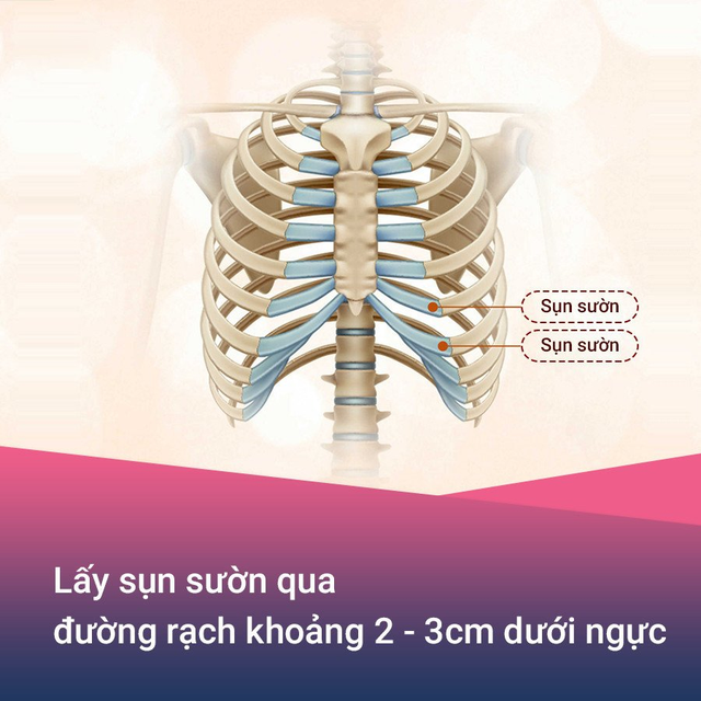 Bác sĩ Trần Doãn Lâm giải đáp về hiệu quả của nâng mũi sụn sườn tự thân - Ảnh 2.