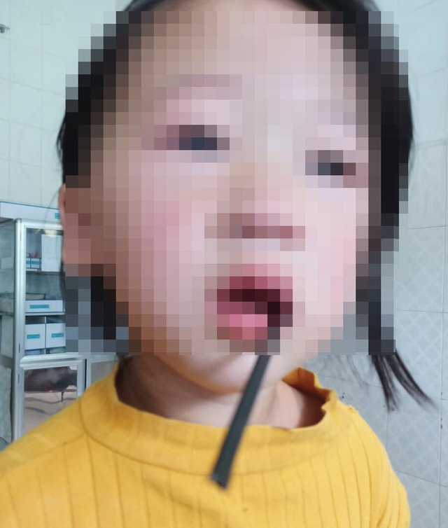 Phẫu thuật lấy thanh sắt đâm vào khoang miệng bé gái 4 tuổi
 - Ảnh 1.