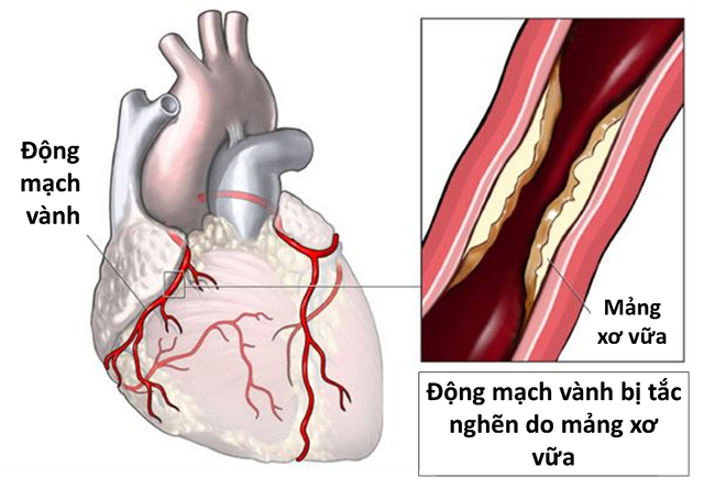 Các dấu hiệu nhận biết bệnh nhồi máu cơ tim cấp - Ảnh 1.