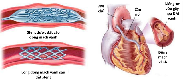 Các dấu hiệu nhận biết bệnh nhồi máu cơ tim cấp - Ảnh 4.