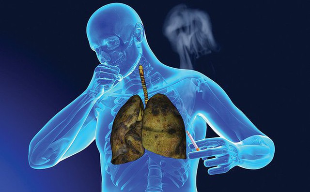 NSƯT Tiến Hợi qua đời vì ung thư phổi: 4 dấu hiệu dễ nhận biết nhất nhưng rất dễ bị bỏ qua! - Ảnh 4.