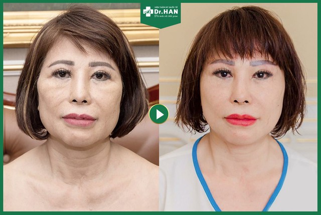 Hỏi đáp về nâng cơ trẻ hóa bằng chỉ không tiêu Hoa Kỳ - Ảnh 4. Hỏi đáp về nâng cơ trẻ hóa bằng chỉ không tiêu Hoa Kỳ - Ảnh 4.