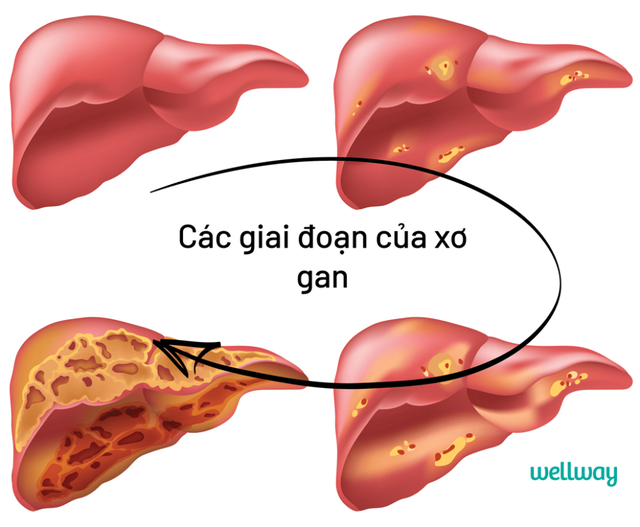 Mới 26 tuổi, cô gái mắc ung thư gan vì thói quen ăn uống sai cách mà nhiều người vẫn mắc phải - Ảnh 3.